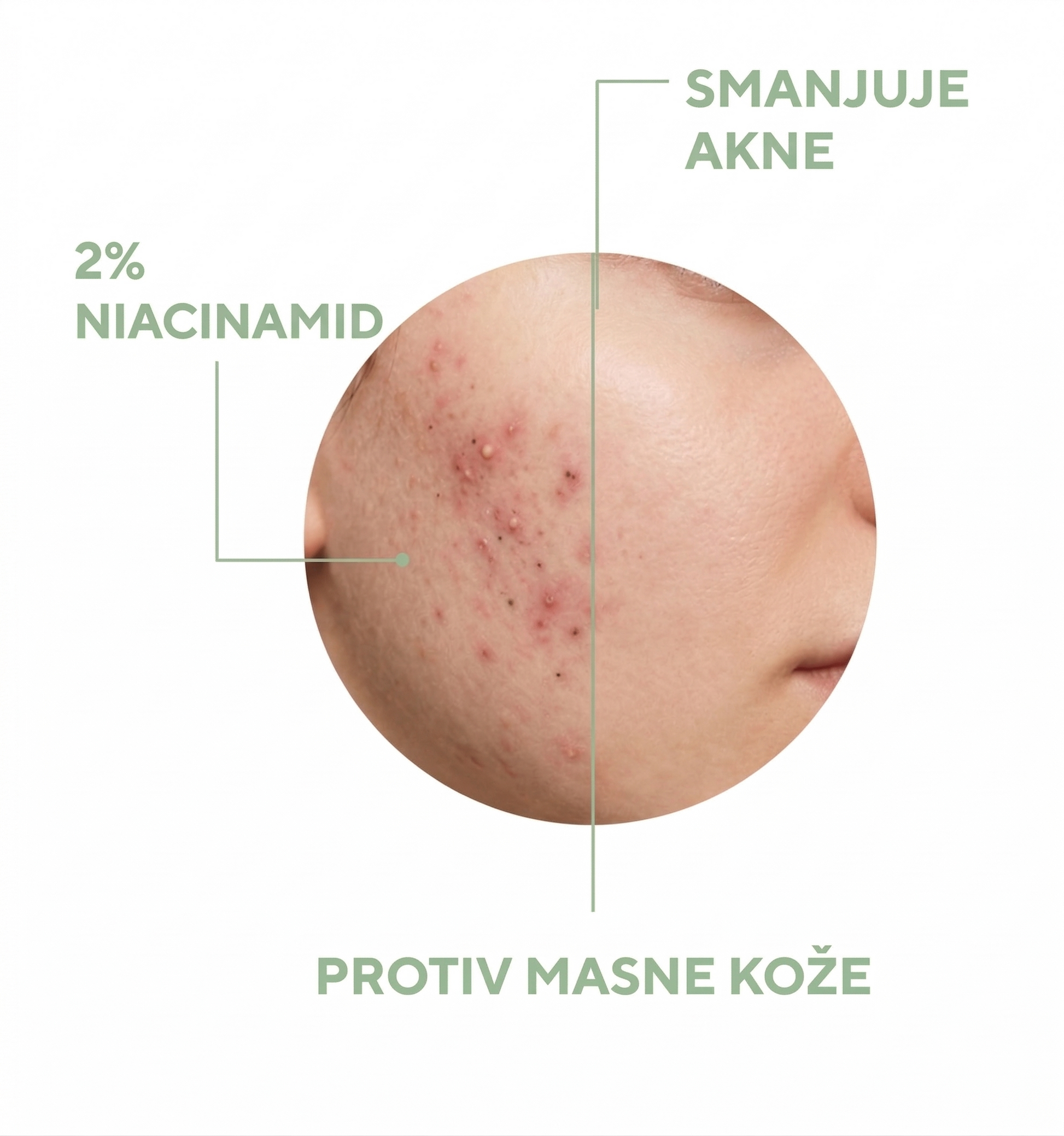 Serum za Akne i Pore